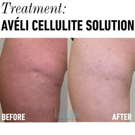 Best procedure for cellulite .